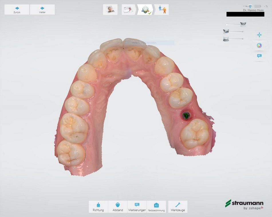 Abb. 8: Fünf Monate später ist das Implantat bereit für die Versorgung: Der Screenshot zeigt die Situation nach Entfernen des Gingivaformers und intraoralem Scan des Weichgewebstrichters.