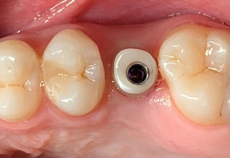 Abb. 11: Einprobe des Zirkonoxid-Hybridabutments: Der gering erscheinende distale Abstand zu Zahn 27 ist projektionsbedingt.