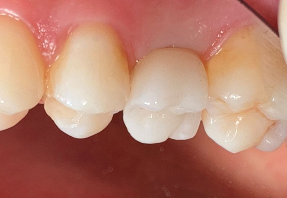 Abb. 12: Mit dem implantatprothetischen Ergebnis, aber auch mit dem Behandlungsverlauf, ist die Patient sehr zufrieden.