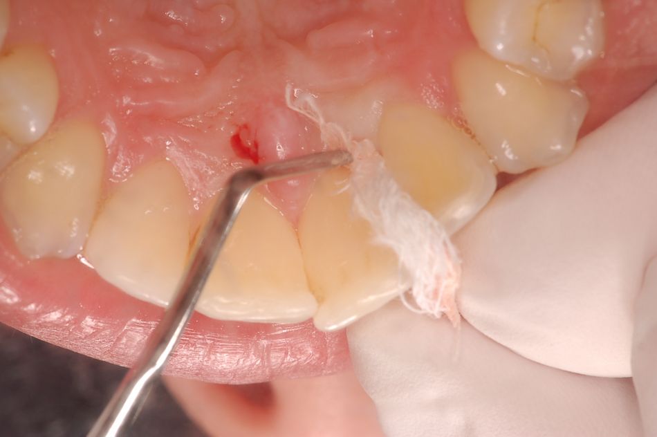 Abb. 3: Um die Gingiva zu retrahieren, benutzt Kim mit Kochsalz getränkte kleine Gazestreifen, bringt sie in die Tasche ein und belässt sie für zwei Minuten. Nach dem Entfernen ist der Taschenboden gut zu erkennen. Es verbleibt genügend Zeit, um Straumann Prefgel (EDTA) und Emdogain auf die Wurzeloberfläche aufzutragen. (Abbildung: Zahnarztpraxis Kim & Herzog, Osnabrück)