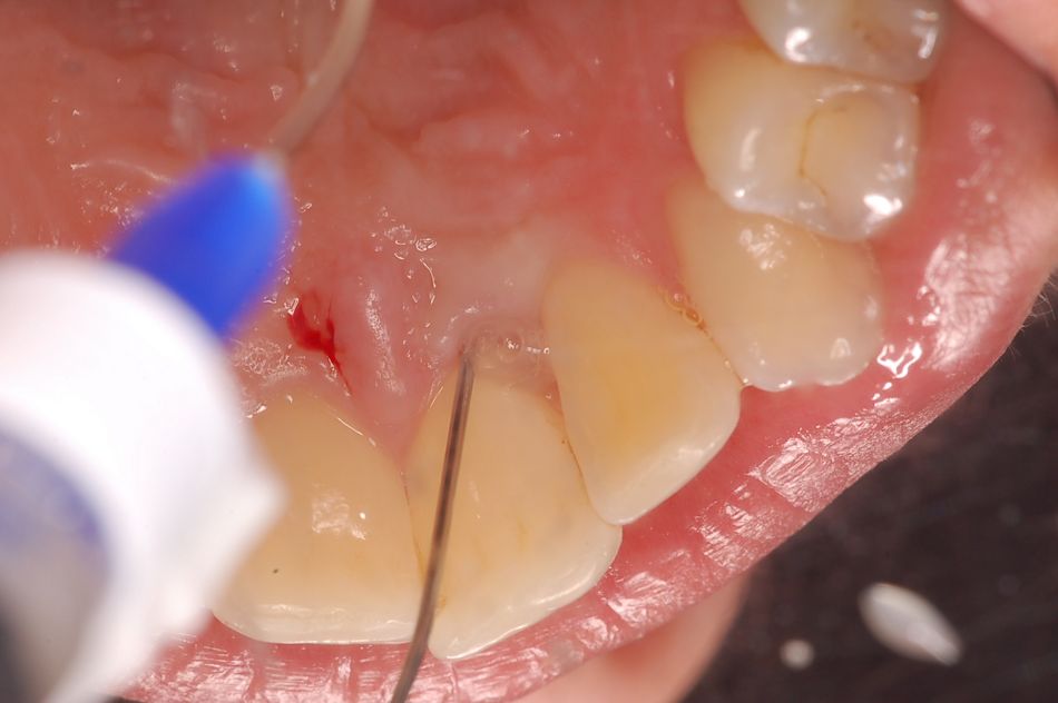 Abb. 4: Nach dem Spülen mit steriler Kochsalzlösung, Konditionierung der Wurzeloberfläche mit Straumann PrefGel (EDTA) und nochmaligem Spülen kann Emdogain FL in die Parodontaltasche appliziert werden. (Abbildung: Zahnarztpraxis Kim & Herzog, Osnabrück)