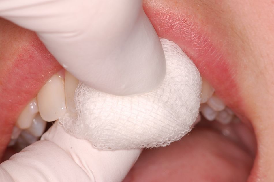 Abb. 6: Adaptation der Gingiva durch einminütiges Pressen mit einer kochsalzgetränkten Gazetuper bukkal und oral. (Abbildung: Zahnarztpraxis Kim & Herzog, Osnabrück)