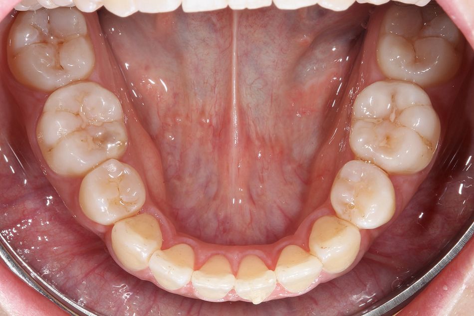 Abb. 2d: Unterkiefer nach der Alignertherapie