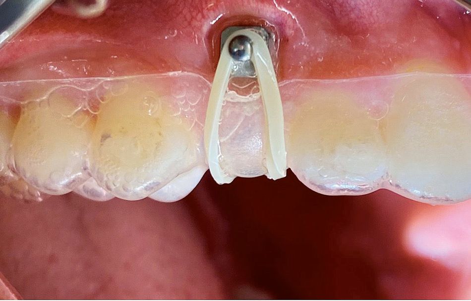Abb. 6: Auch Fälle, die sonst den klassischen kieferorthopädischen Gerätschaften vorbehalten sind, lassen sich mit Alignern lösen und in den ClearCorrect Treatment-Plan implementieren, hier die Mobilisation des retinierten Zahns 13.