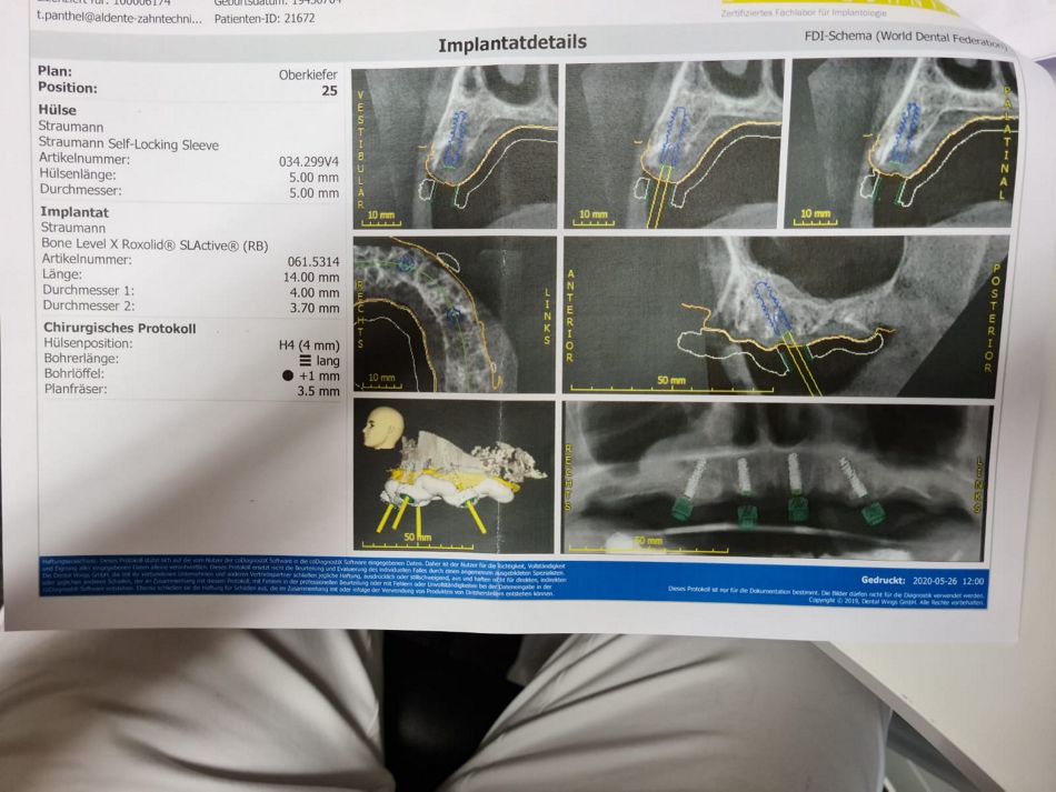 Abb. 1: Auf dem Weg zu „Smile in the Box“: Die Planung erfolgte im Straumann Planungslabor al dente Zahntechnik, Oliver Beckmann, 57258 Freudenberg mit CoDiagnostiX. Es wurden im Oberkiefer vier Straumann Bone Level X (BLX)-Implantate Regular Base (RB) mit dem Durchmesser Ø 4.0 und der Länge 14mm in regio 15, 22 und 25 sowie der Länge 12mm in regio 12 geplant.  (Abbildungen: ZA Haider Salem, Wassenberg)