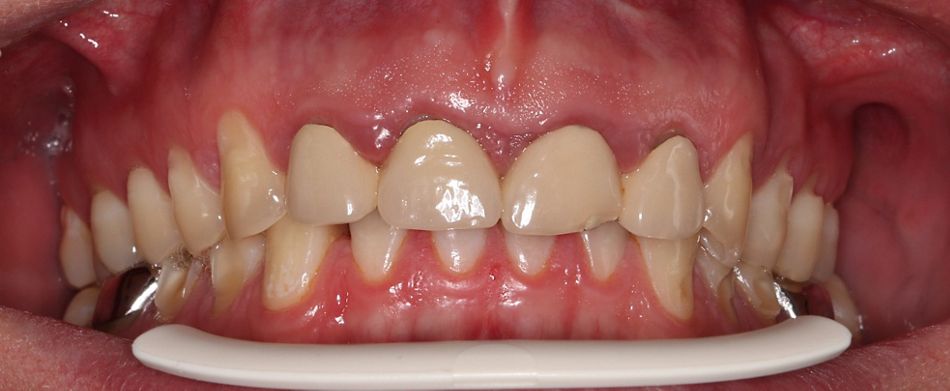 Abb. 2a: Die Zähne 12 bis 22 sind endodontisch vorbehandelt und mit einem Kronenblock versorgt. Die Krone 21 ist inzisal frakturiert. 