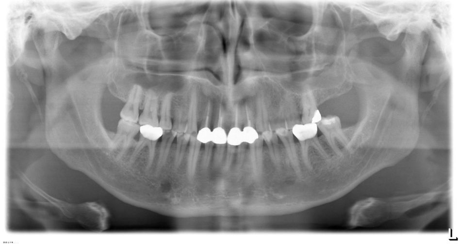 Abb. 2b: Die Zähne 12 bis 22 sind endodontisch vorbehandelt und mit einem Kronenblock versorgt. Die Krone 21 ist inzisal frakturiert. 