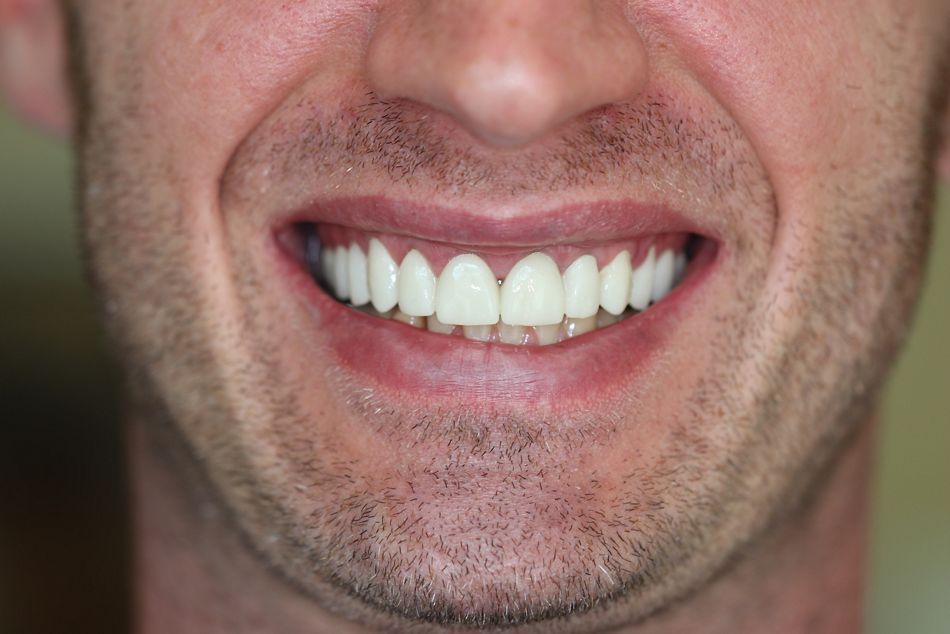 Abb. 4a: Ergebnis nach drei Monaten mit girlandenförmigen Gingivaverlauf und optimierten Proportionen zwischen Kronen und Gingiva 
