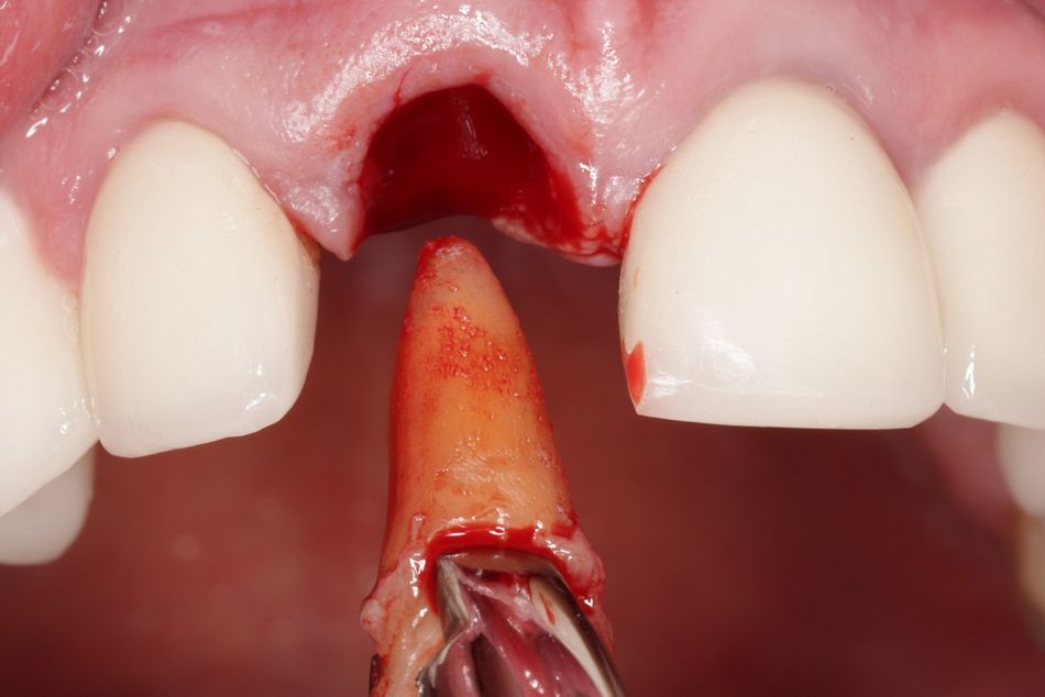 Abb. 6: Behutsame Extraktion des Zahnes unter maximaler Schonung der Alveolenwände. 