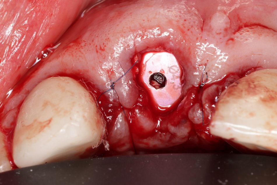 Abb. 9: Verschluss des Implantats regio 11 mit Einheilkappe (2 mm)