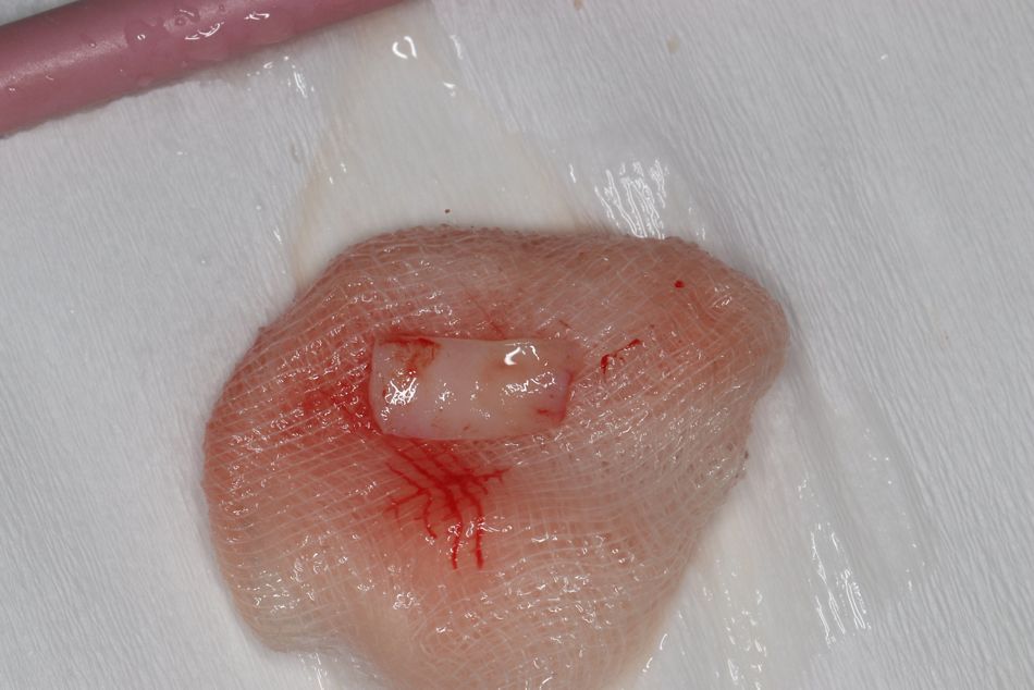 Abb. 10: Aus dem Gaumen entnommenes Schleimhauttransplantat 