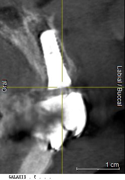 Abb. 13: Röntgenkontrolle nach Insertion des Implantats regio 11