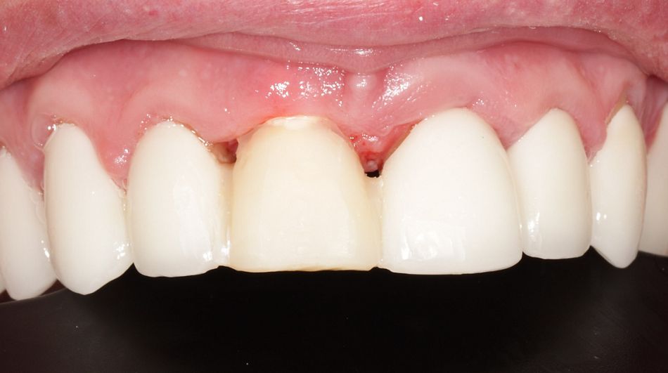Abb. 14a: Situation nach Einheilzeit (provisorisches Abutment aus PEEK und Komposit-Brücke)