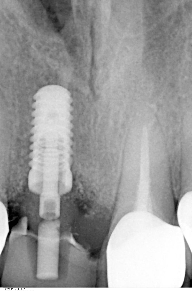 Abb. 14b: Situation nach Einheilzeit (provisorisches Abutment aus PEEK und Komposit-Brücke)