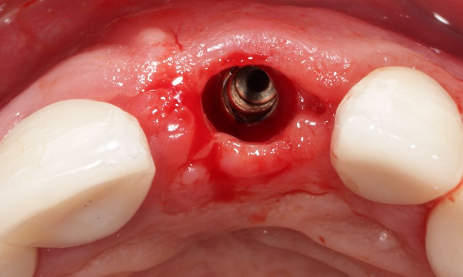 Abb. 15: Nach der Ausformung des Emergenzprofils mit 4 mm-hohem Gingivaformer 