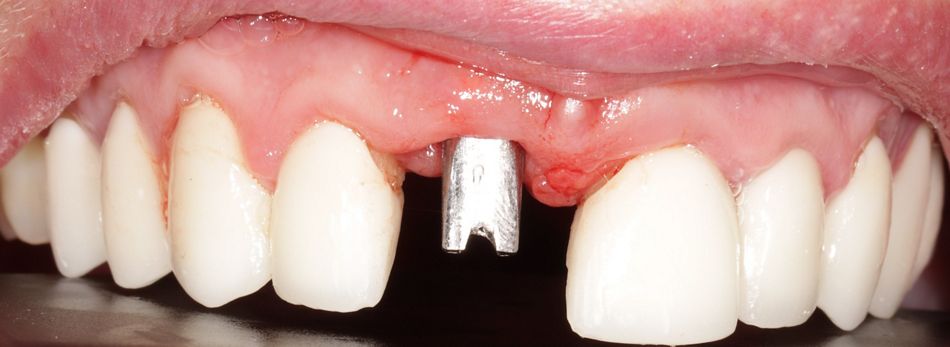 Abb. 16: Situation mit verschraubtem Abutment 