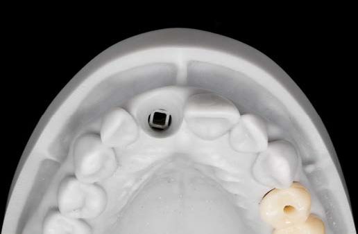 Abb. 15: Implantatmodell mit klassischem Laboranalog von Straumann.