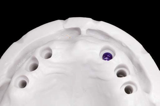 Abb. 16: Implantatmodell mit Medentika-Laboranalog.