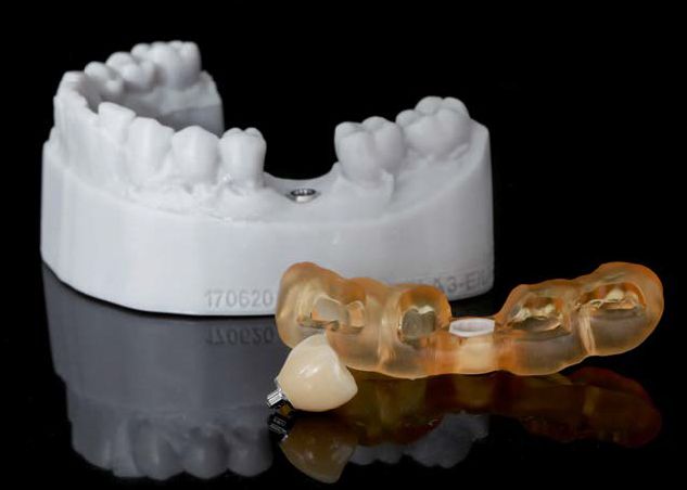 Abb. 21: Der 3D-Druck spielt im digitalen implantatprothetischen Workflow eine Protagonisten-Rolle: gedrucktes Modell, gedruckte Bohrschablone, gedruckte temporäre Implantatkrone.