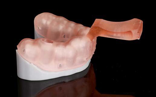 Abb. 5: Im Materialportfolio stehen verschiedene 3D-Resine für Löffel zur Verfügung. Transparentes Material kann bei Implantat-Abformungen von Vorteil sein. Die manuelle Nacharbeit ist auf ein Minimum reduziert.
