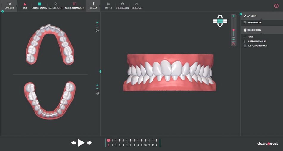 Abb. 2: Oberkiefer bzw. Unterkiefer in der Aufsicht. Vor Behandlungsstart und Herstellung der Aligner sendet ClearCorrect einen 3D-Behandlungsplan, der jeden Schritt der Aligner-Behandlung erfasst und ein zielgerechtes Arzt-Patient-Aufklärungsgespräch ermöglicht. Hier: Bildschirmabzug aus der Software ClearPilot, die dem Behandler die 3D-Planung (Initialplanung mit 12 Schienen bei 14-tägiger Trageweise) visualisiert.