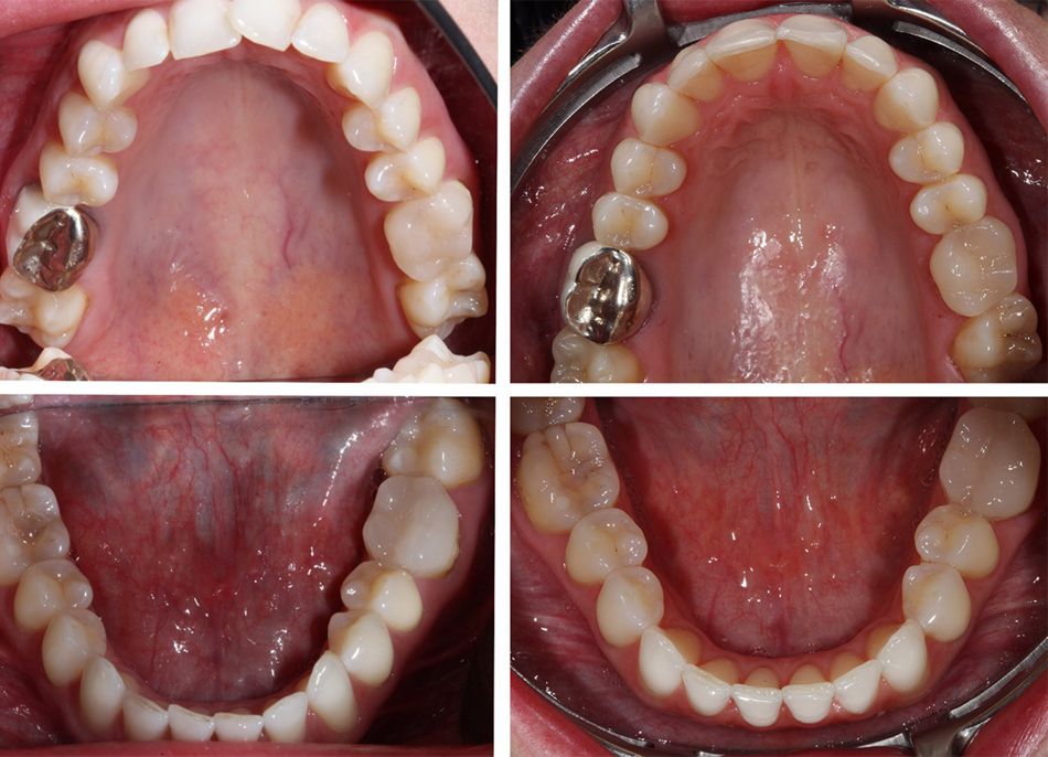 Abb. 8: Vorher-Nachher: links: Oberkiefer und Unterkiefer in der Aufsicht vor Beginn der Behandlung mit ClearCorrect, rechts: entsprechende Aufsicht-Aufnahmen nach Abschluss der Aligner-Therapie nach finalem Refinement nach 13 Monaten