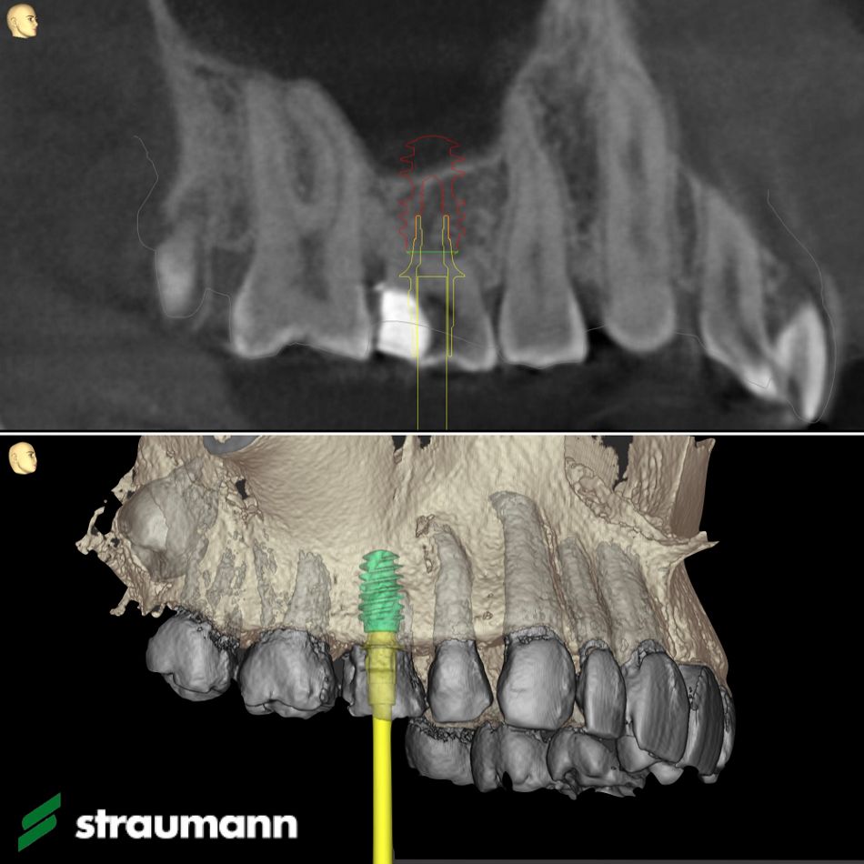 Abb. 2: Smile in a Box Planung – Matching DVT-Scan und 3Shape-Scan