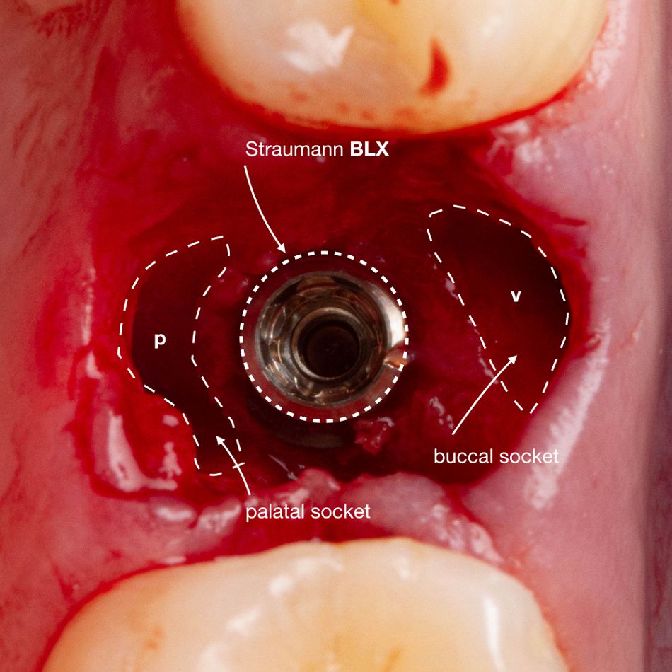 Abb. 15: Positionierung des BLX Implantats im Verhältnis zu palatinaler und vestibulärer Alveole