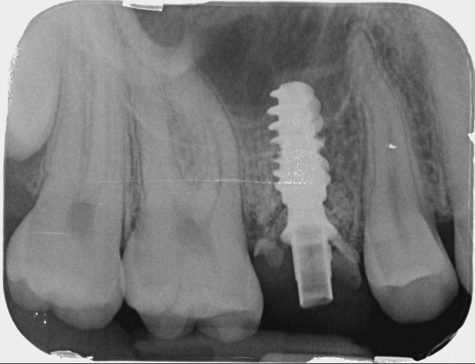 Abb. 18: Postoperative Röntgenkontrolle mit Variobase