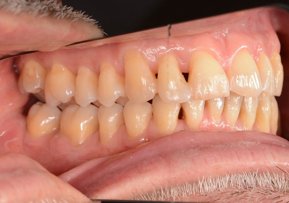 Abb. 3: Fotodokumentation: Zustand nach einem Jahr vor UPT (unterstützende Parodontaltherapie): Das Foto zeigt eine gesunde, rosafarbene, gestippelte Gingiva. Der Patient hat einen adäquate Mundhygiene.