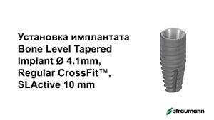 Установка имплантата: Straumann® Bone Level Tapered