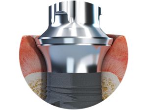 Straumann® TLX Implant System