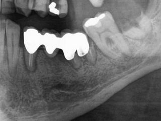 Single-tooth (Cement retained)
