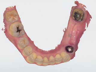 Single-tooth (Cement retained)