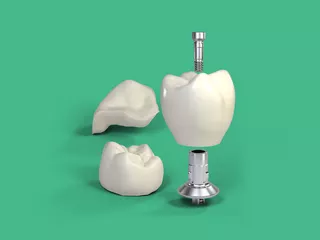 Permanent restoration