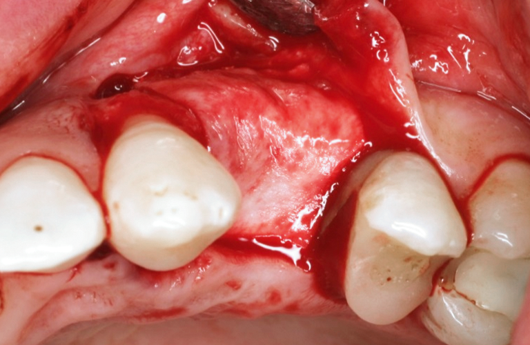 collagen membranes in regenerative