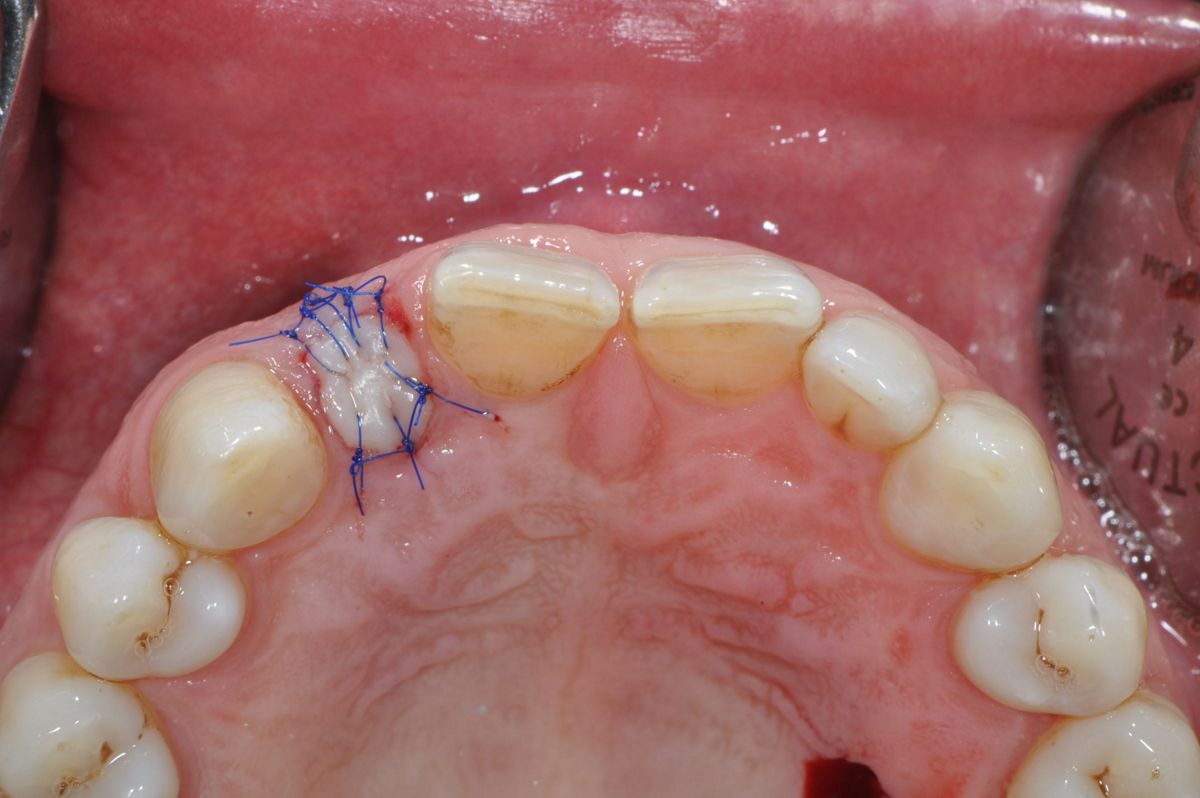 Use Of The Straumann Bone Level Tapered Implant O 2 9 Mm In The Esthetic Zone