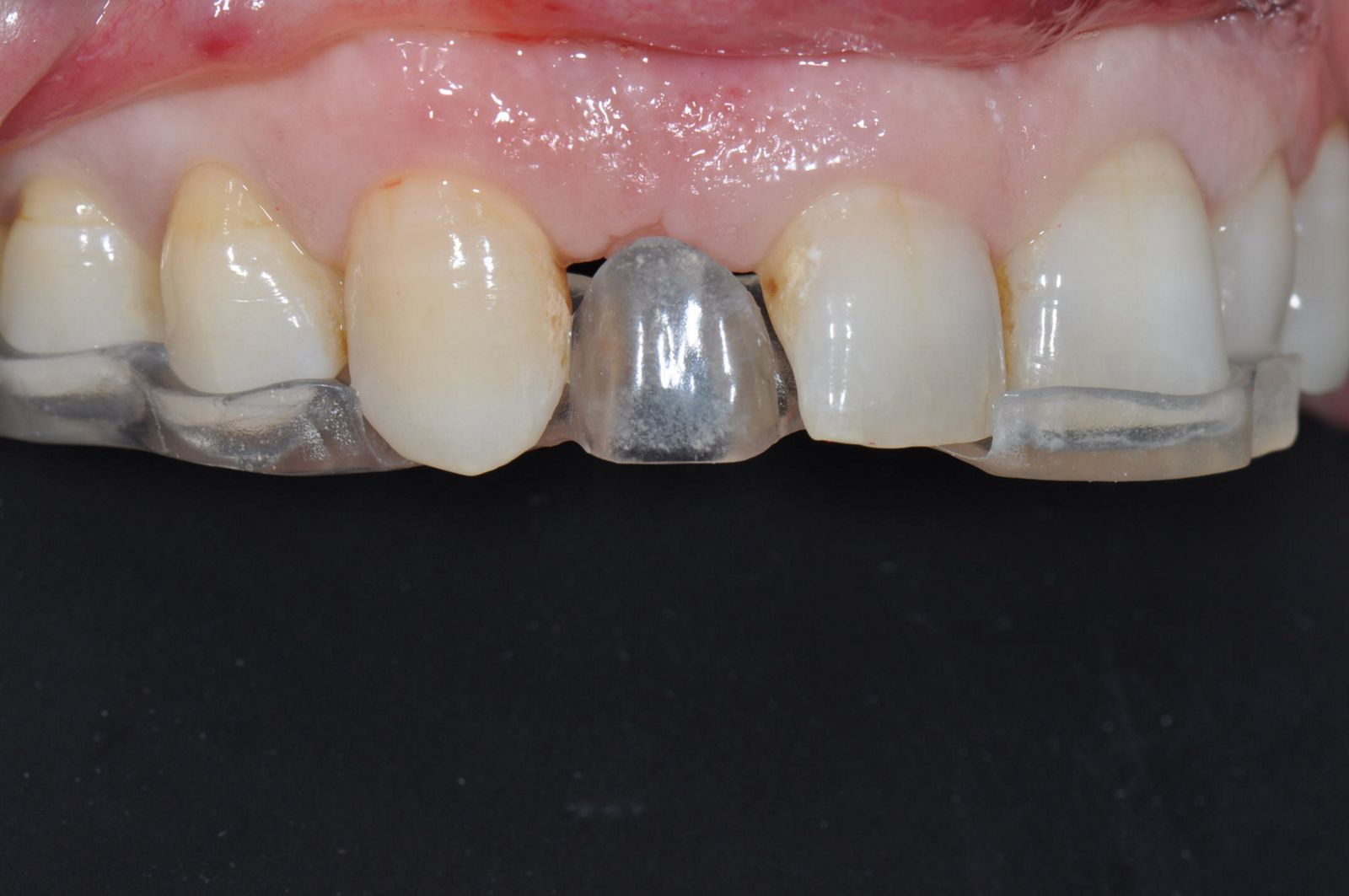 Use Of The Straumann Bone Level Tapered Implant O 2 9 Mm In The Esthetic Zone