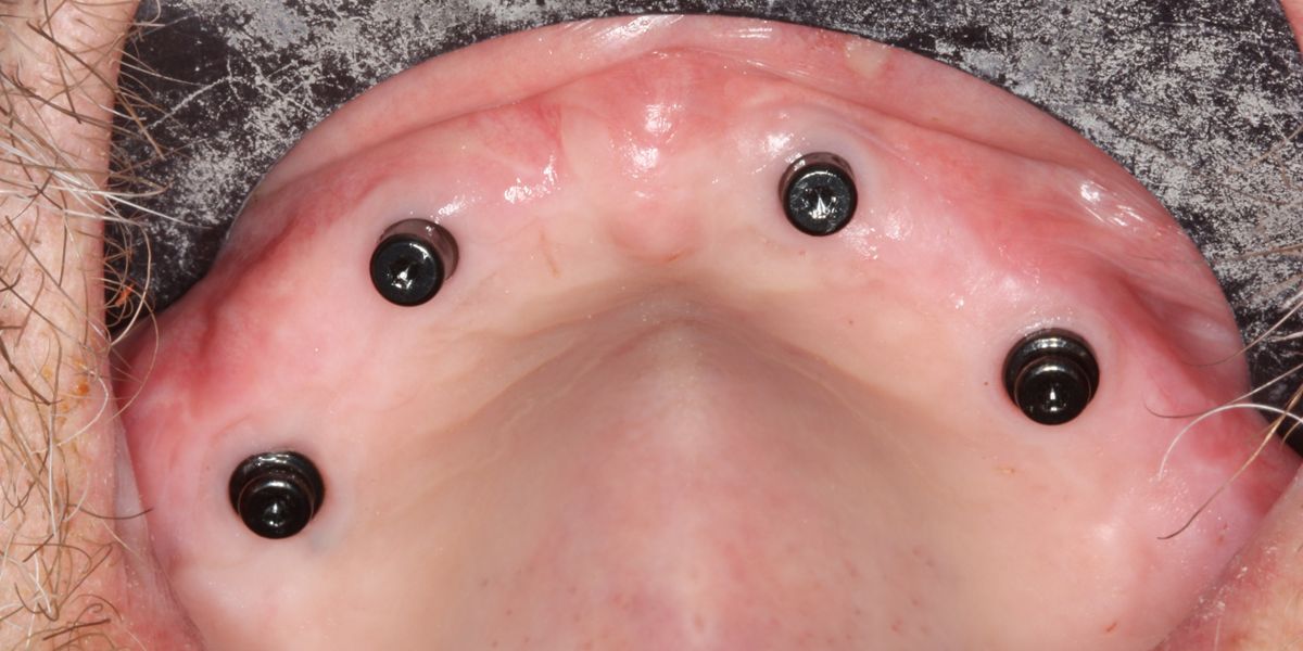 Straumann Novaloc ®. Rehabilitation of a fully edentulous maxilla