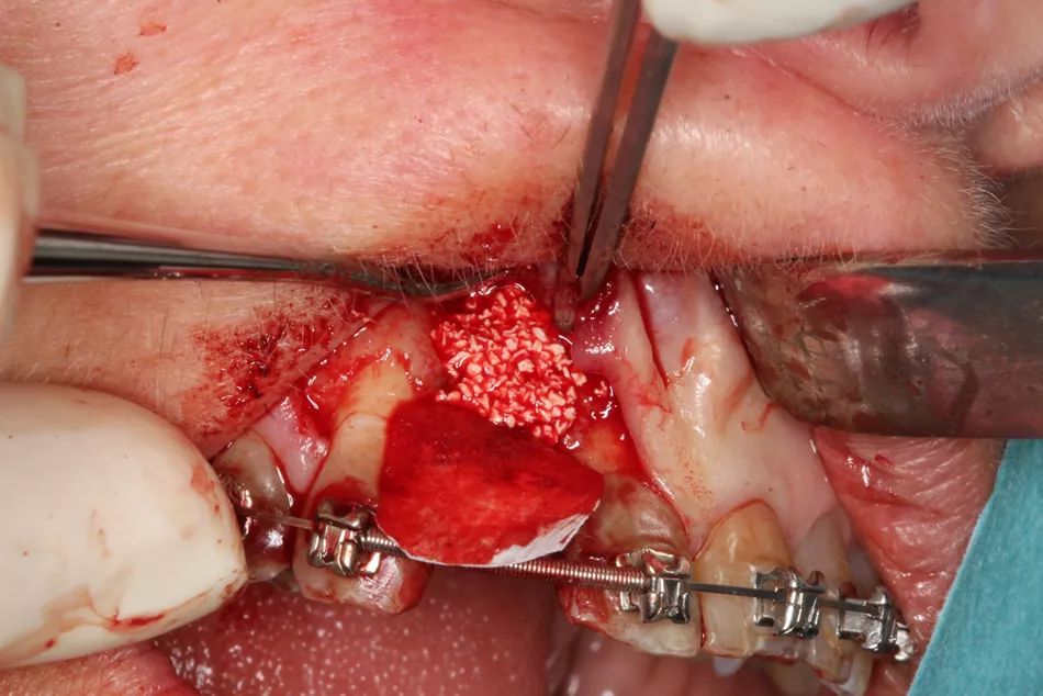 Fig. 6: The Jason® membrane can be used for all augmentations, including small GBR procedures (case by Dr. Michael Kristensen).