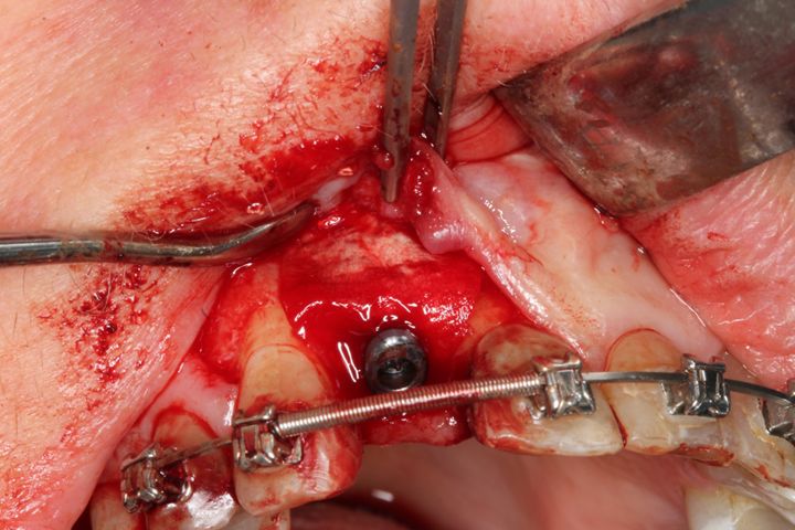Abb. 7: In diesen Situationen kann aufgrund der hervorragenden Gewebeadhäsion der Membran auf eine Fixierung mit Pins verzichtet werden. Der koronale Teil der Membran wurde mit der Implantatschraube befestigt.