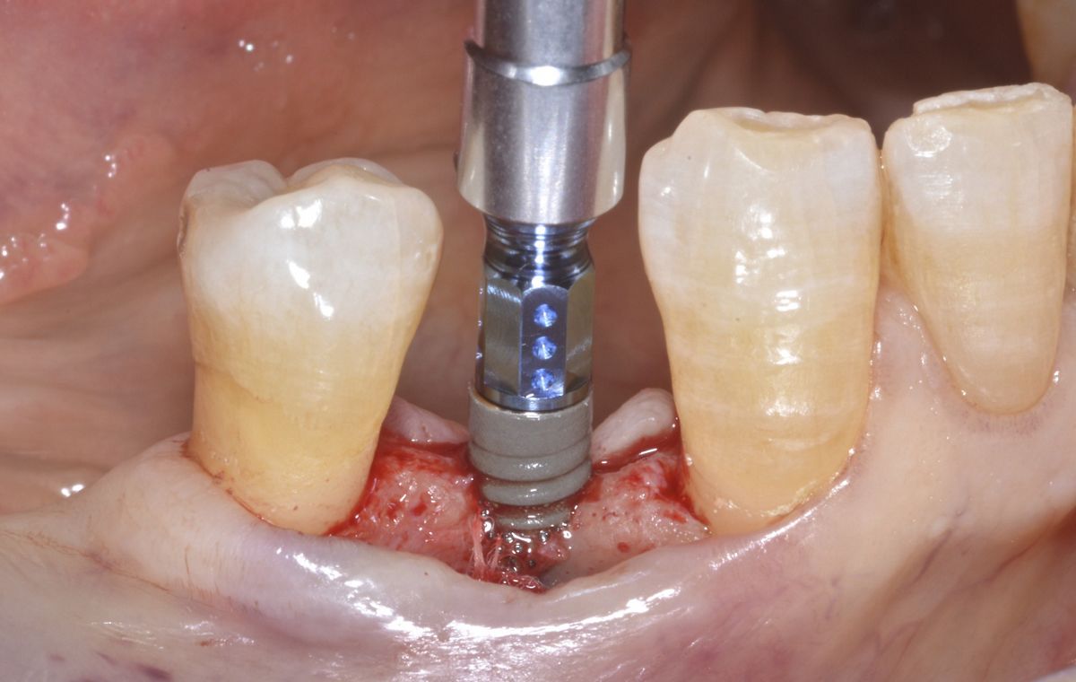 使用33mmstraumann03骨水平小直径种植体和botissmucoderm03减少