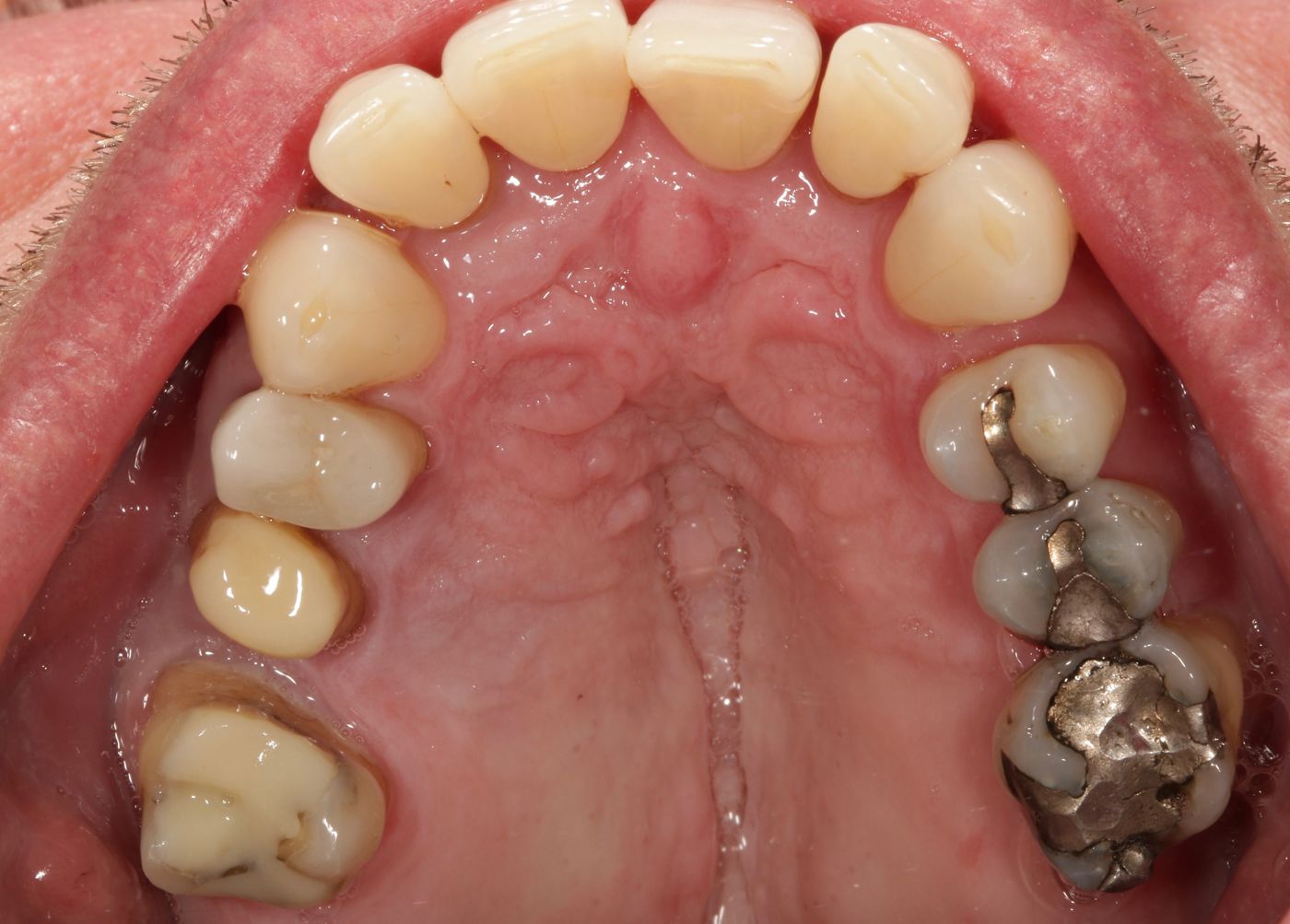 Fig. 2: The patient wished replacement of the...