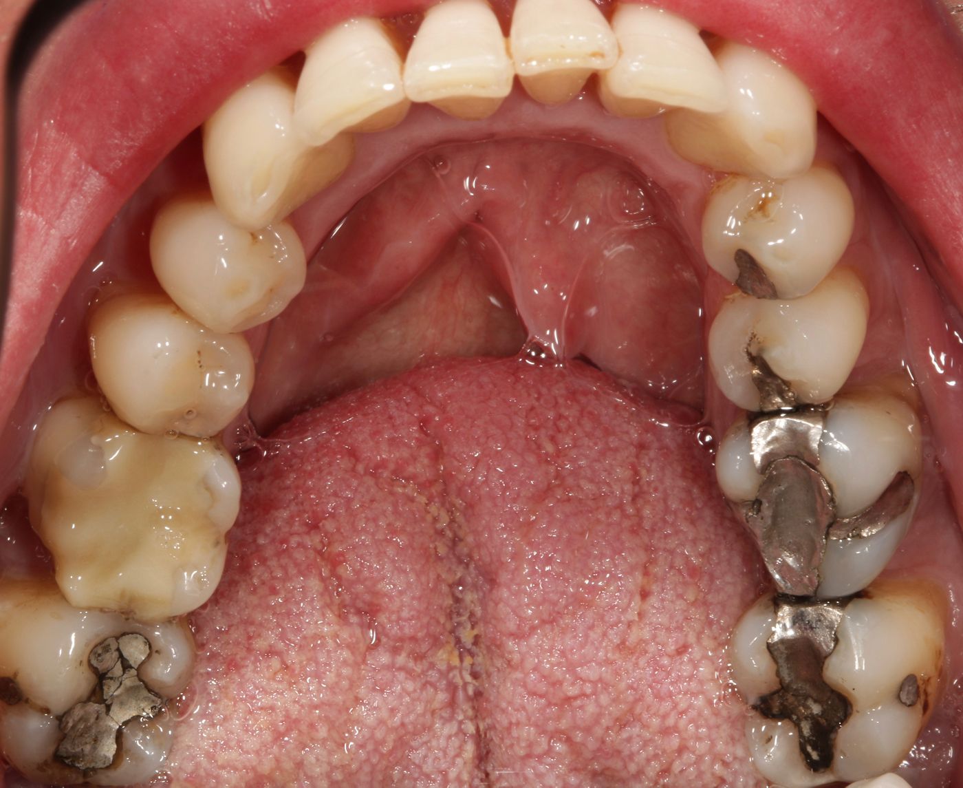 Fig. 3: ...large surface amalgam fillings with fully ceramic restorations