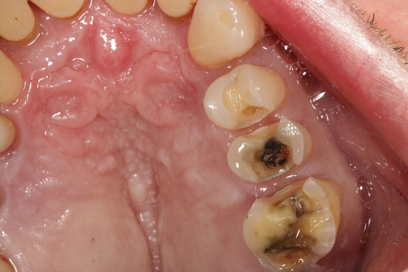 Fig. 4: The prepared teeth...