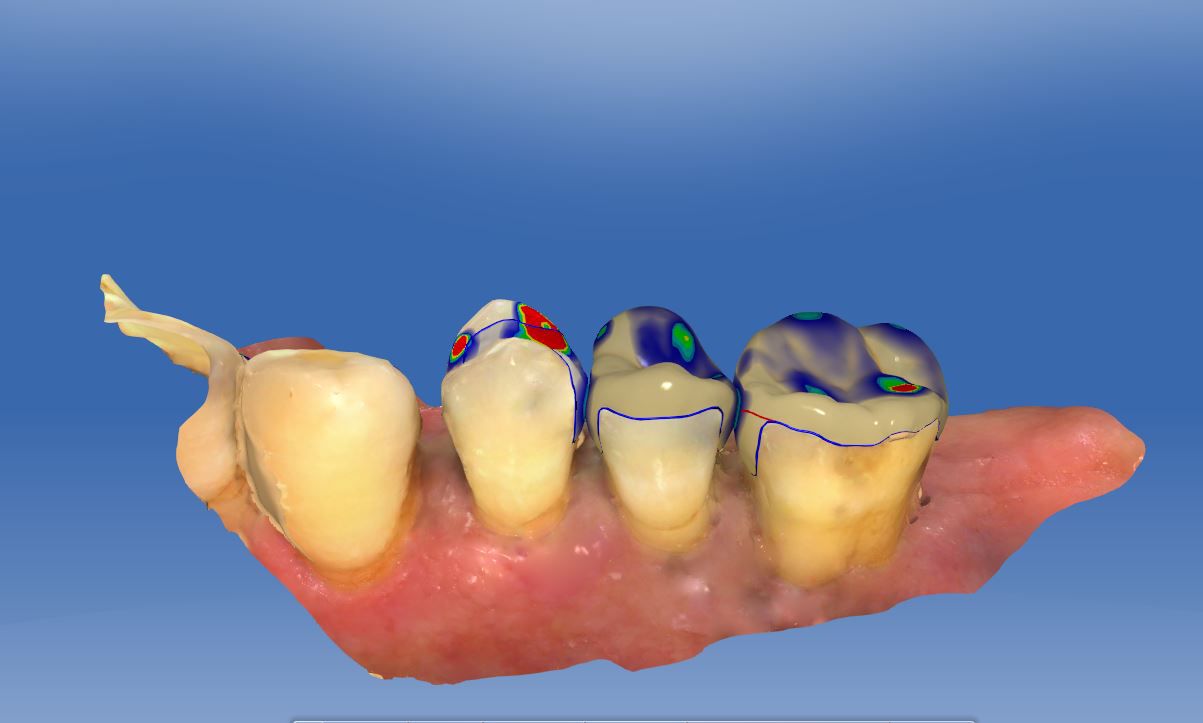 Fig. 7a ... in the posterior segment of the maxilla