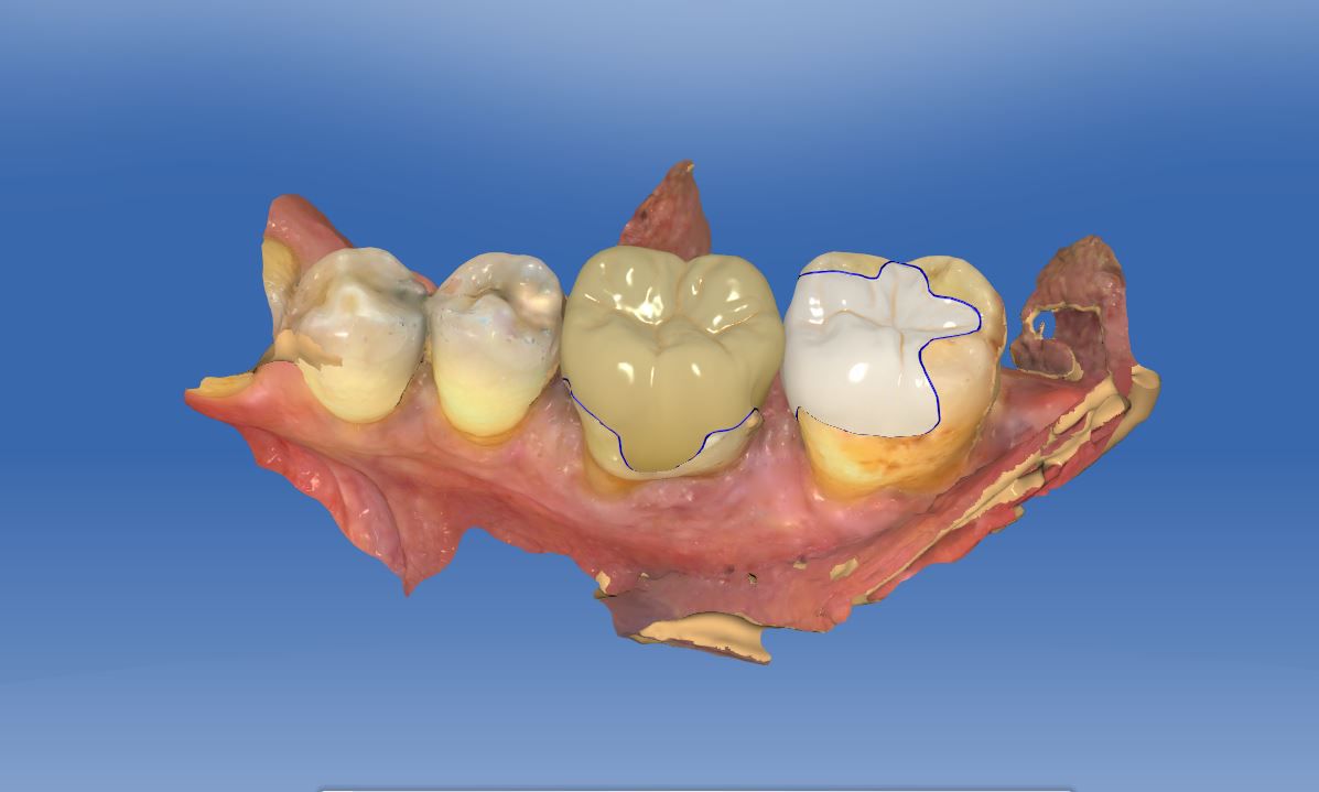 Fig. 8a CAD construction in the mandible