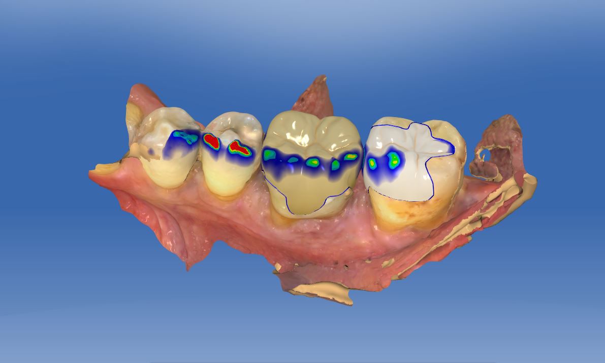 Fig. 8b CAD construction in the mandible