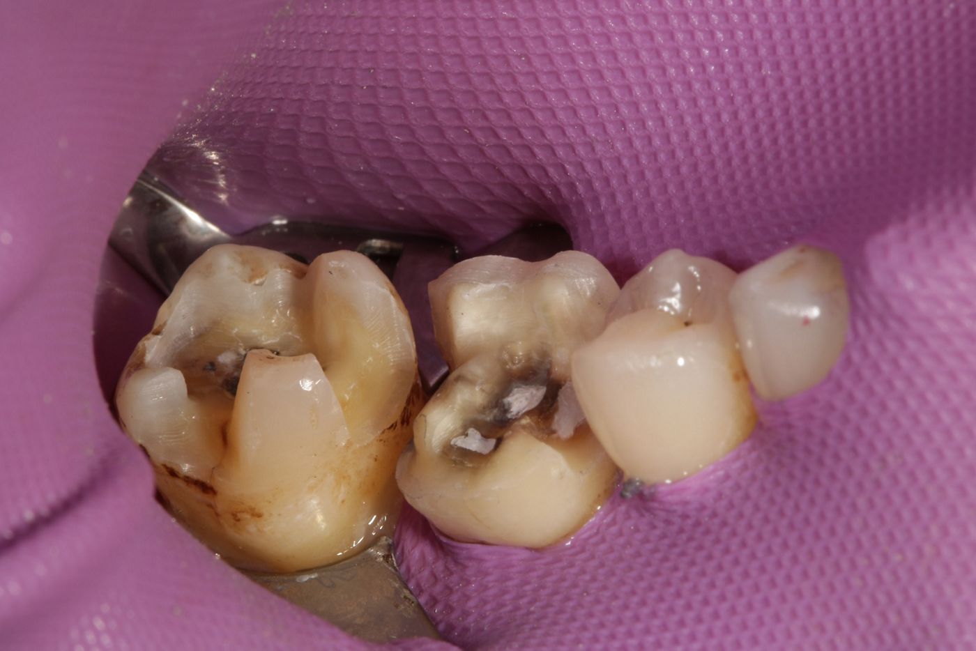 Fig. 11 The teeth are conditioned for adhesive placement of the glass-ceramic restorations.