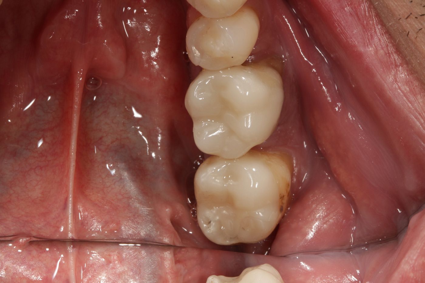 Fig. 12 Restorations inserted in the mandible.